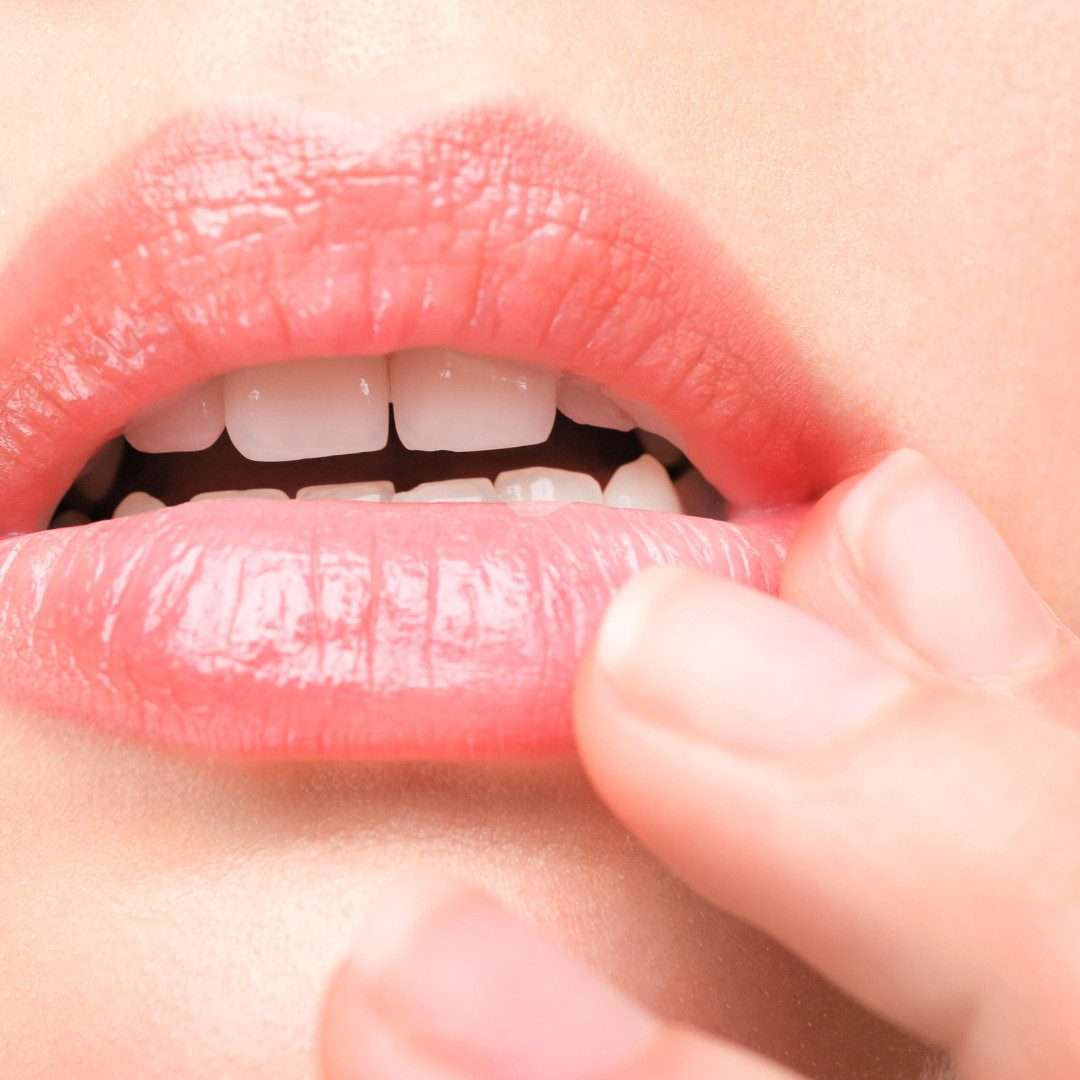 Herpes Labial: O que é, como tratar e como prevenir esta lesão tão comum